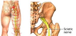 טיפול באישיאס סיאטיקה Sciatica - הסוף לכאבי אישיאס